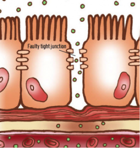 leaky gut